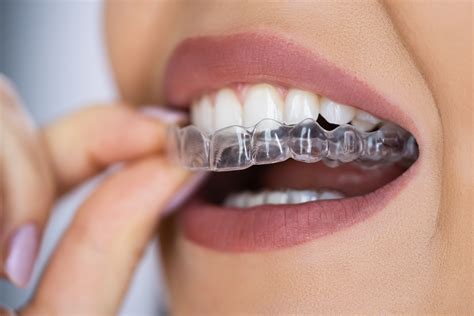 best orthodontist near 10930|Teeth Straightening 